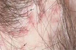 正常毛囊和不正常毛囊图片