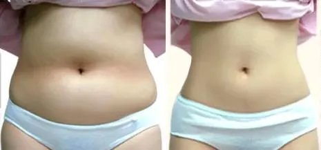 深圳超声波吸脂好吗