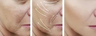 如何能去除脸部皱纹 去除脸部皱纹的几个原因细说