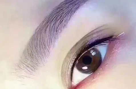 韩式埋线双眼皮拆线吗