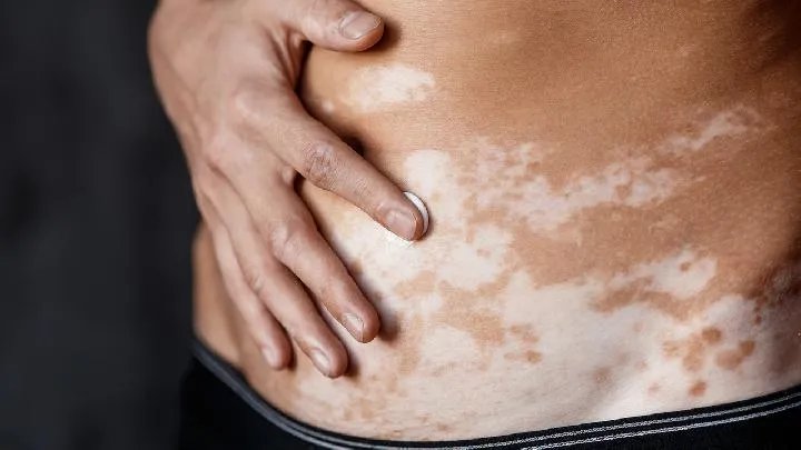 治疗白癜风的方法有哪些呢？