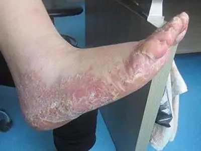 脓疱性肢端皮炎脱屑图片