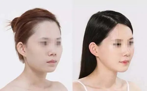 假体隆鼻手术前后对比效果