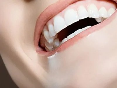 做一颗种植牙大概多少钱