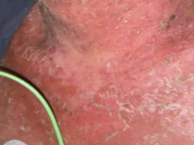 脓疱性肢端皮炎脱屑图片