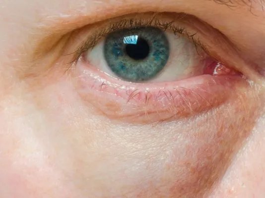 怎样去眼袋最有效