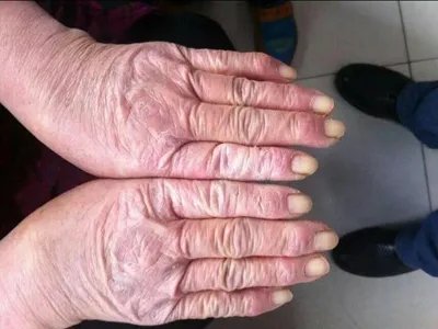 手部湿疹手背皮肤粗糙图片