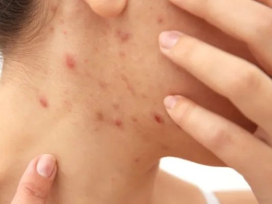 怎样快速消除青春痘