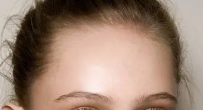 玻尿酸去抬头纹能维持多久