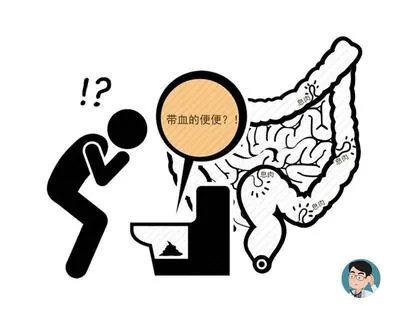 女子灌肠肠道穿孔：这种排毒“新手段”，害惨了多少中国女性？