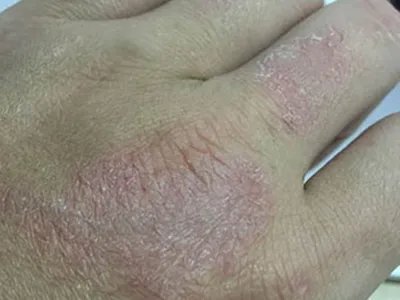 手部湿疹手背皮肤粗糙图片