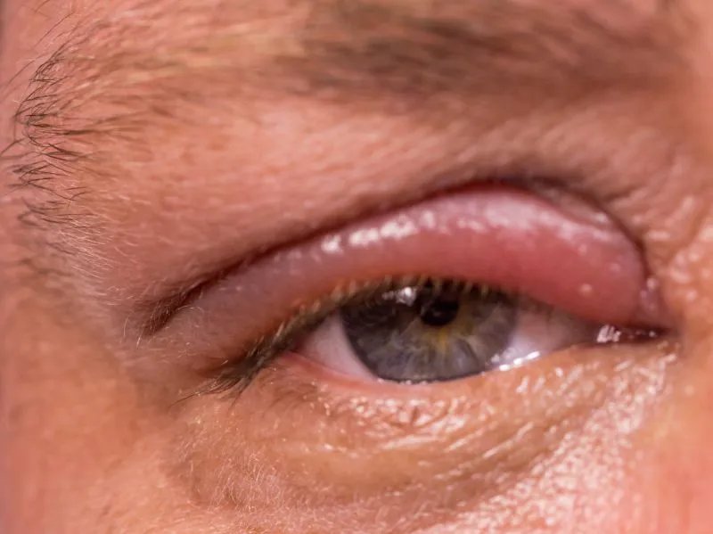 如何去治疗虹膜炎