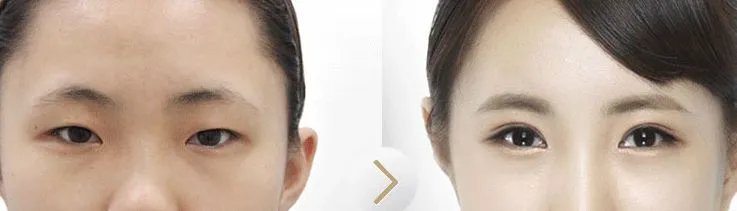 双眼皮手术的优势是什么？